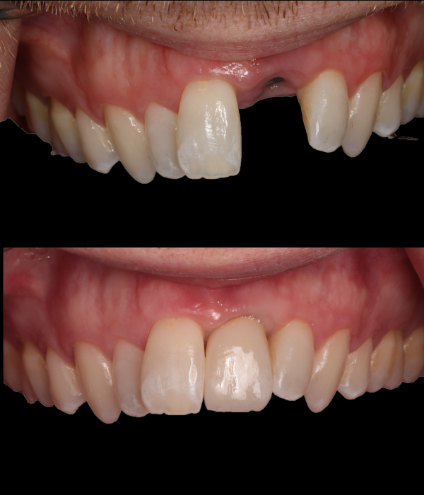 Treatment -  Harcourt Dental Clinic