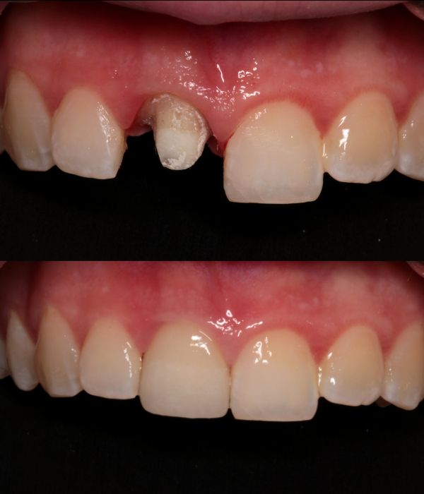 Treatment -  Harcourt Dental Clinic