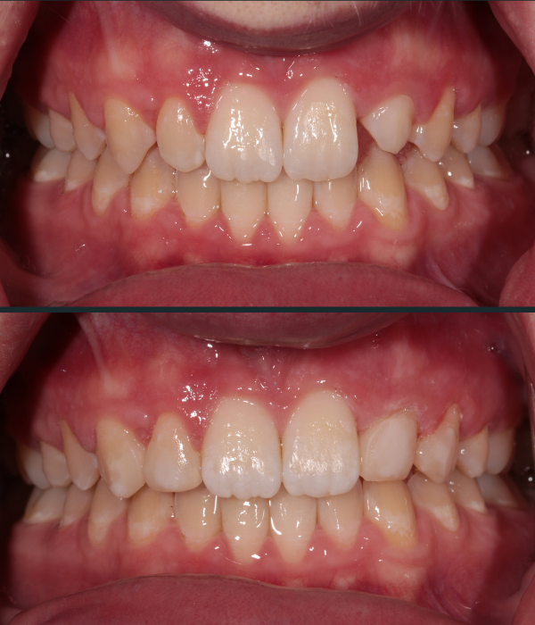 Treatment -  Harcourt Dental Clinic