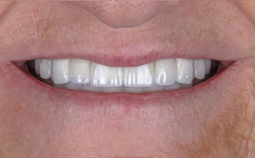 After -Harcourt Dental Clinic