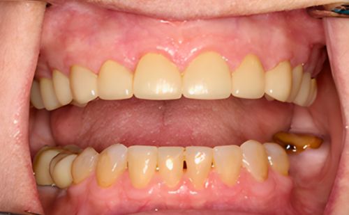 After -Harcourt Dental Clinic