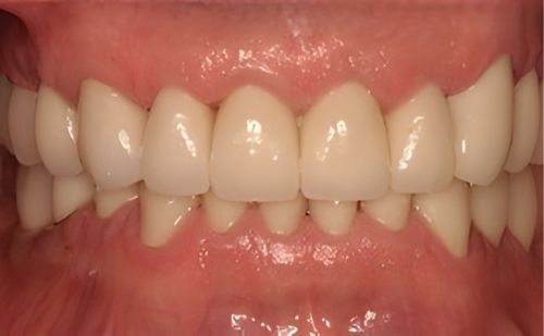 After -Harcourt Dental Clinic