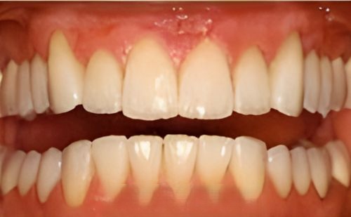 After -Harcourt Dental Clinic