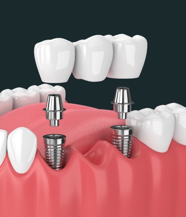 Treatment -  Harcourt Dental Clinic