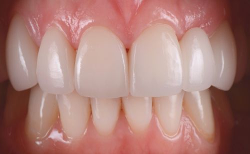 After -Harcourt Dental Clinic