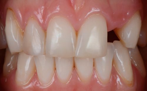 Before - Harcourt Dental Clinic