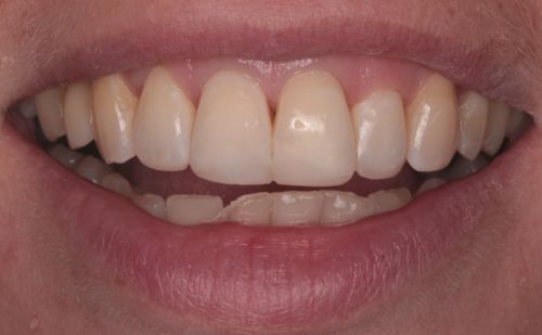 After -Harcourt Dental Clinic