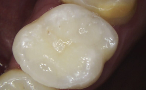 After -Harcourt Dental Clinic