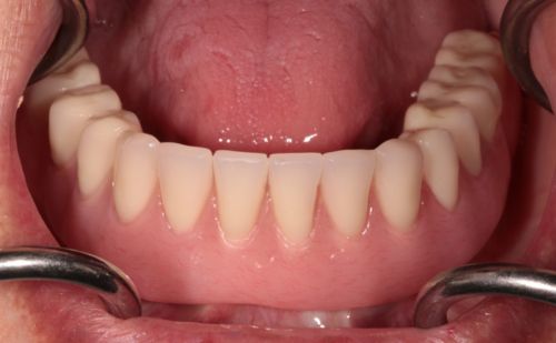 After -Harcourt Dental Clinic