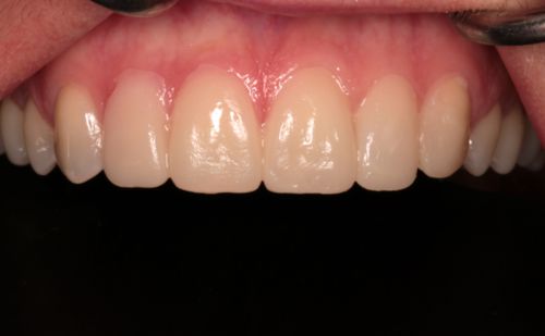 After -Harcourt Dental Clinic