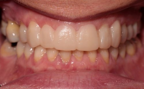 After - Harcourt Dental Clinic