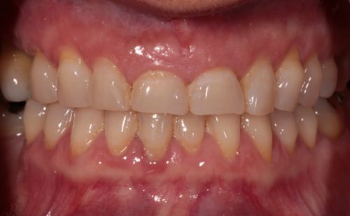 Before - Harcourt Dental Clinic