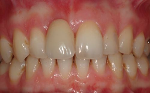 After -Harcourt Dental Clinic