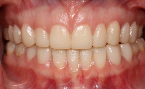 After -Harcourt Dental Clinic