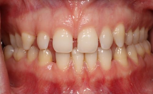 Before - Harcourt Dental Clinic