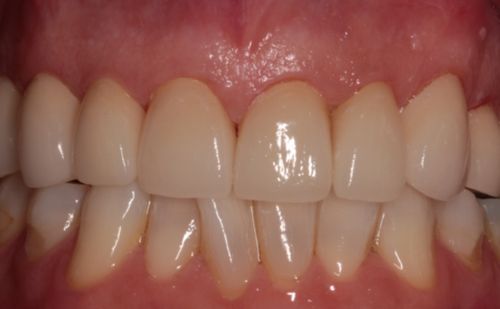 After -Harcourt Dental Clinic