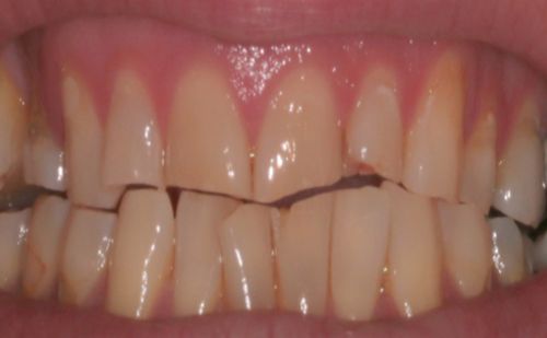 Before - Harcourt Dental Clinic