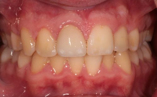 After - Harcourt Dental Clinic