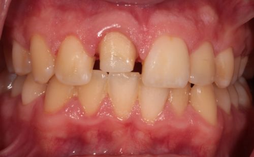 Before - Harcourt Dental Clinic