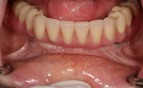 After - Harcourt Dental Clinic