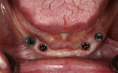 Before - Harcourt Dental Clinic