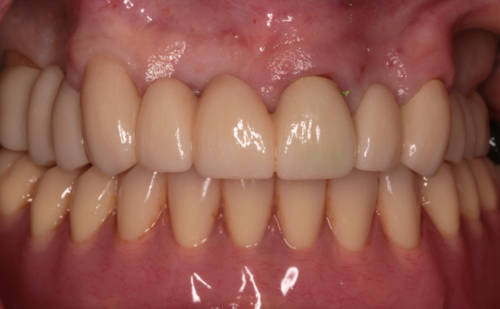 After - Harcourt Dental Clinic