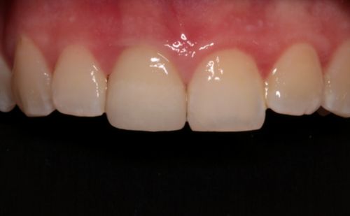 After - Harcourt Dental Clinic