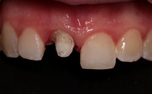 Before - Harcourt Dental Clinic