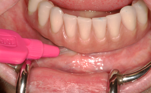 After -Harcourt Dental Clinic