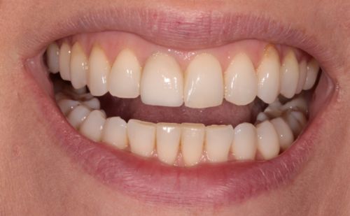 After - Harcourt Dental Clinic