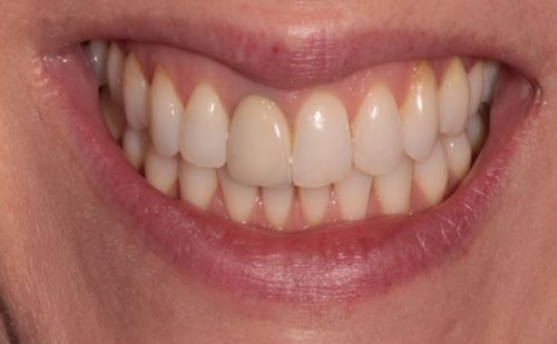 Before - Harcourt Dental Clinic