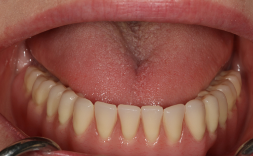 After -Harcourt Dental Clinic