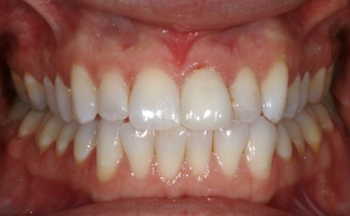 After - Harcourt Dental Clinic