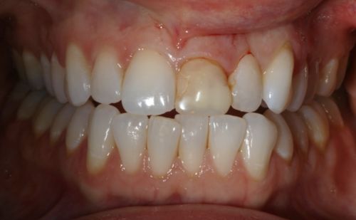 Before - Harcourt Dental Clinic