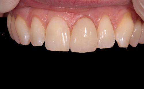 After - Harcourt Dental Clinic