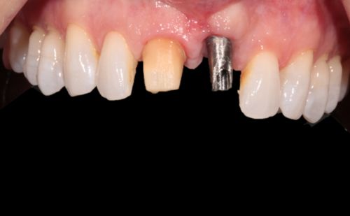 Before - Harcourt Dental Clinic