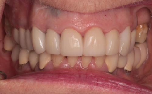 After - Harcourt Dental Clinic