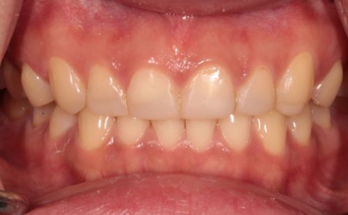 After -Harcourt Dental Clinic