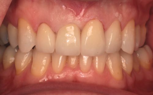 After - Harcourt Dental Clinic