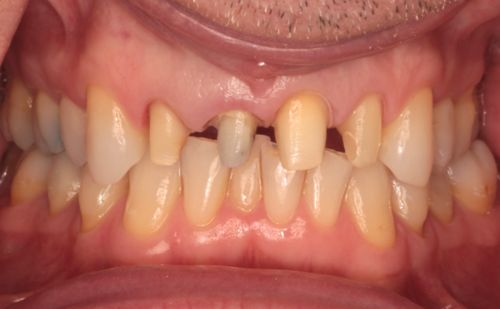 Before - Harcourt Dental Clinic