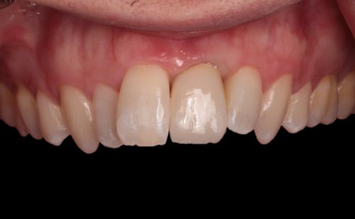 After -Harcourt Dental Clinic