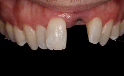 Before - Harcourt Dental Clinic