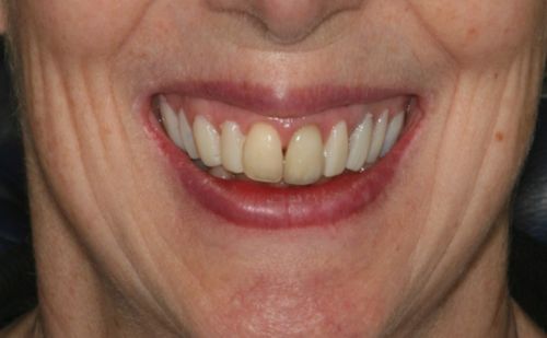 After -Harcourt Dental Clinic