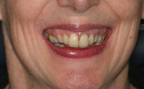 Before - Harcourt Dental Clinic