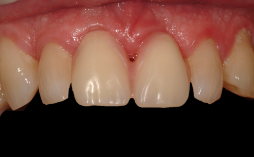 After -Harcourt Dental Clinic
