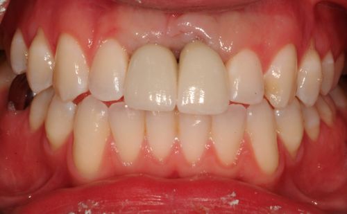 After -Harcourt Dental Clinic