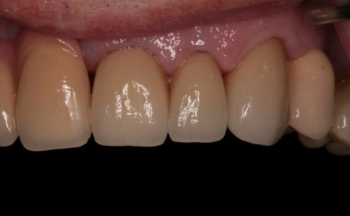 After -Harcourt Dental Clinic