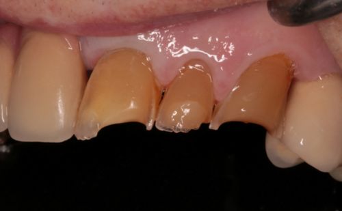 Before - Harcourt Dental Clinic