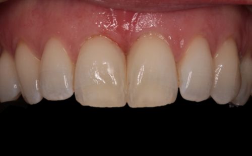 After - Harcourt Dental Clinic