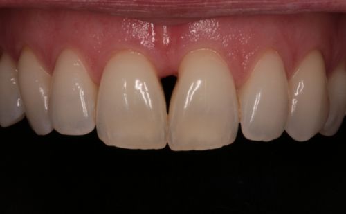 Before - Harcourt Dental Clinic